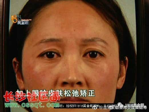 杭州临安芘丽芙医疗美容医院,宋大姐